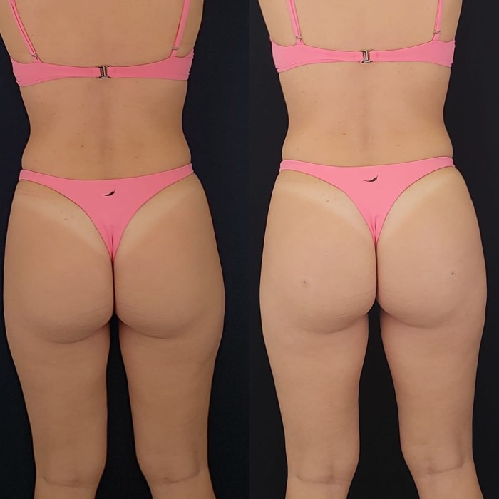 Gluteoplastia Antes e Depois