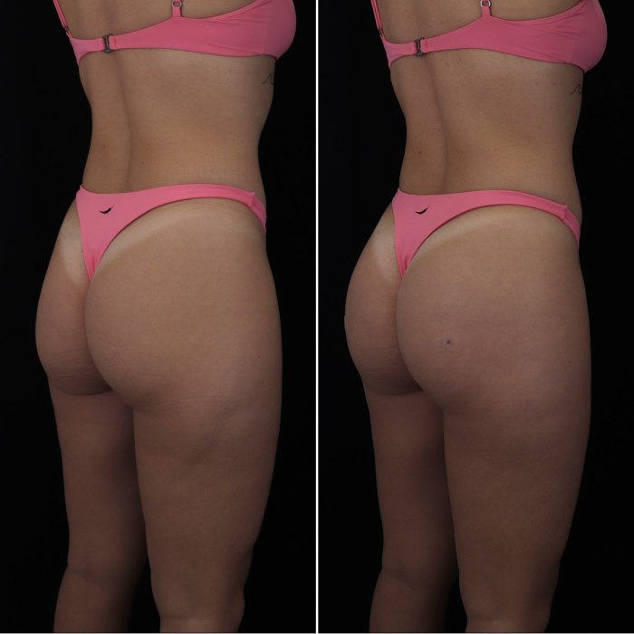 Harmonização de Glúteos Antes e Depois 3
