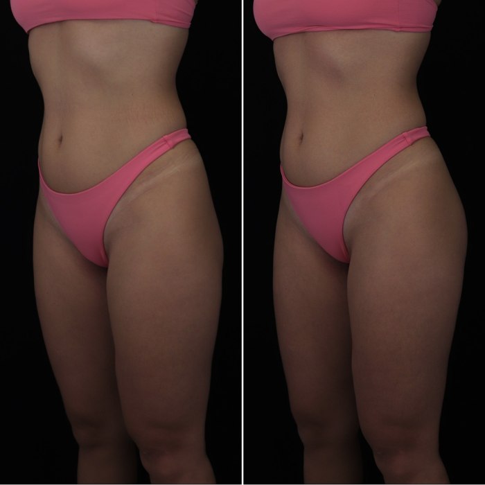 Harmonização de Glúteos Antes e Depois 34