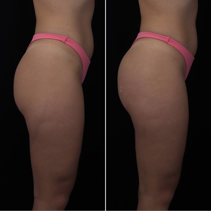 Harmonização de Glúteos Antes e Depois 35