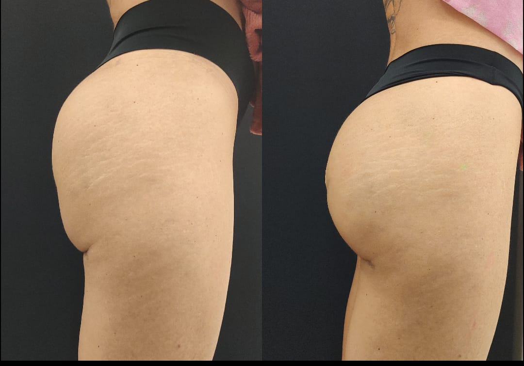 Gluteoplastia-Fotos-Antes-e-Depois-case-7