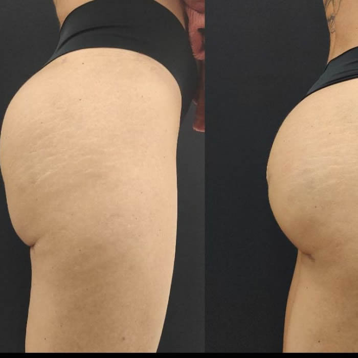 clinabe - harmonizacao glutea dr helbert - foto antes e depois 1